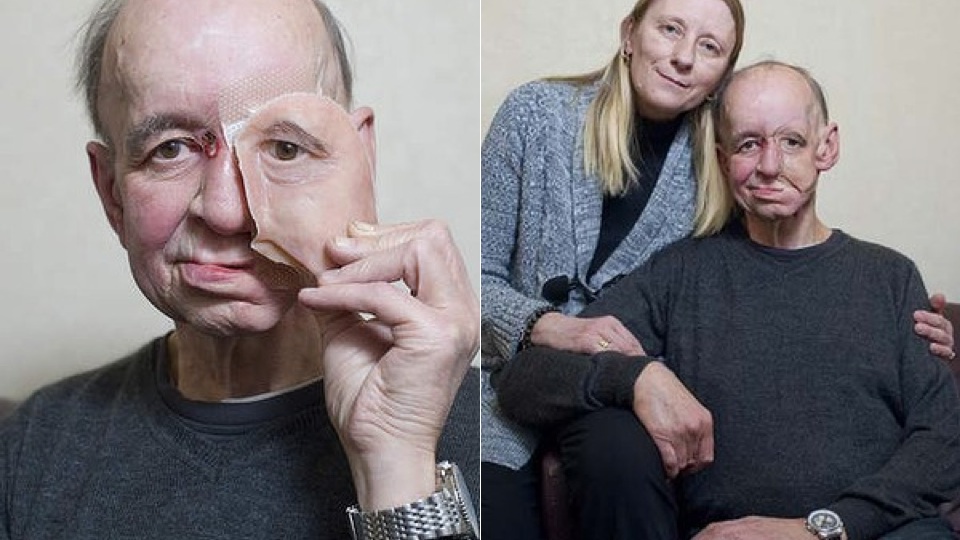 The 3D Printed Prosthetic Face