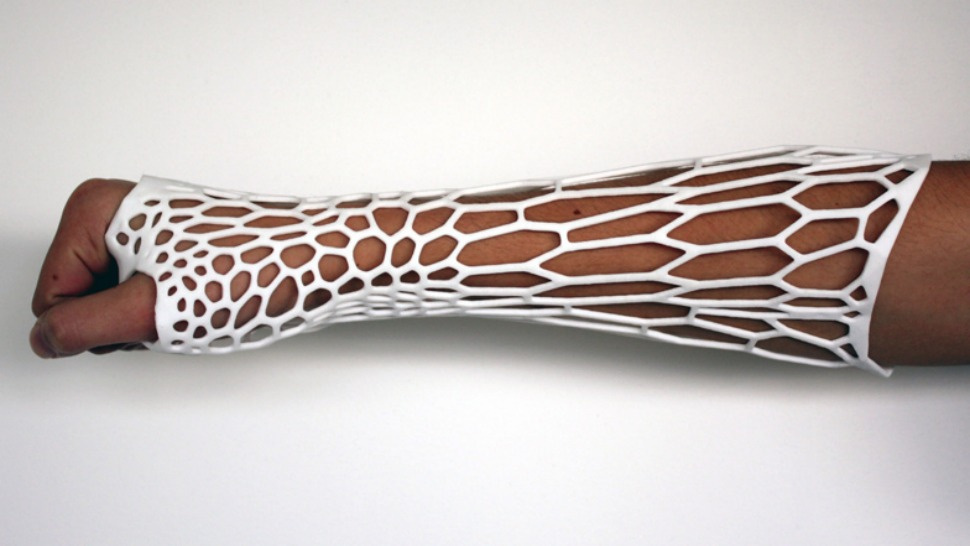  3D Printed Exoskeletal Cast to Mend Fractures